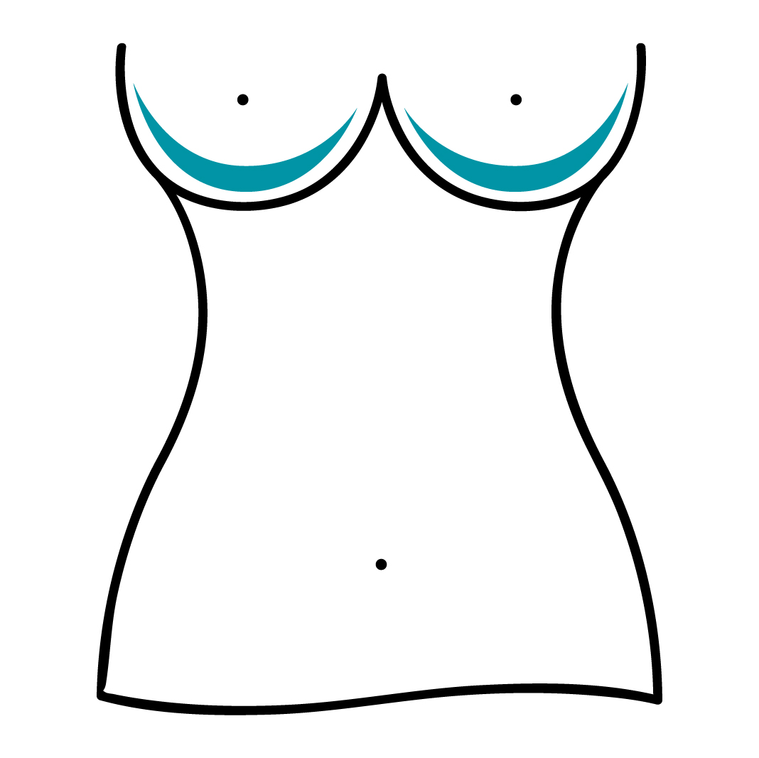 mastoplastica additiva